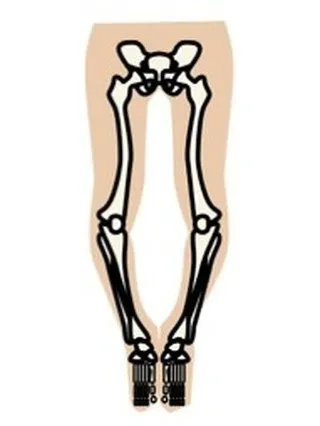 Ｏ脚の原因のひとつとして、骨盤の歪みが挙げられます。
