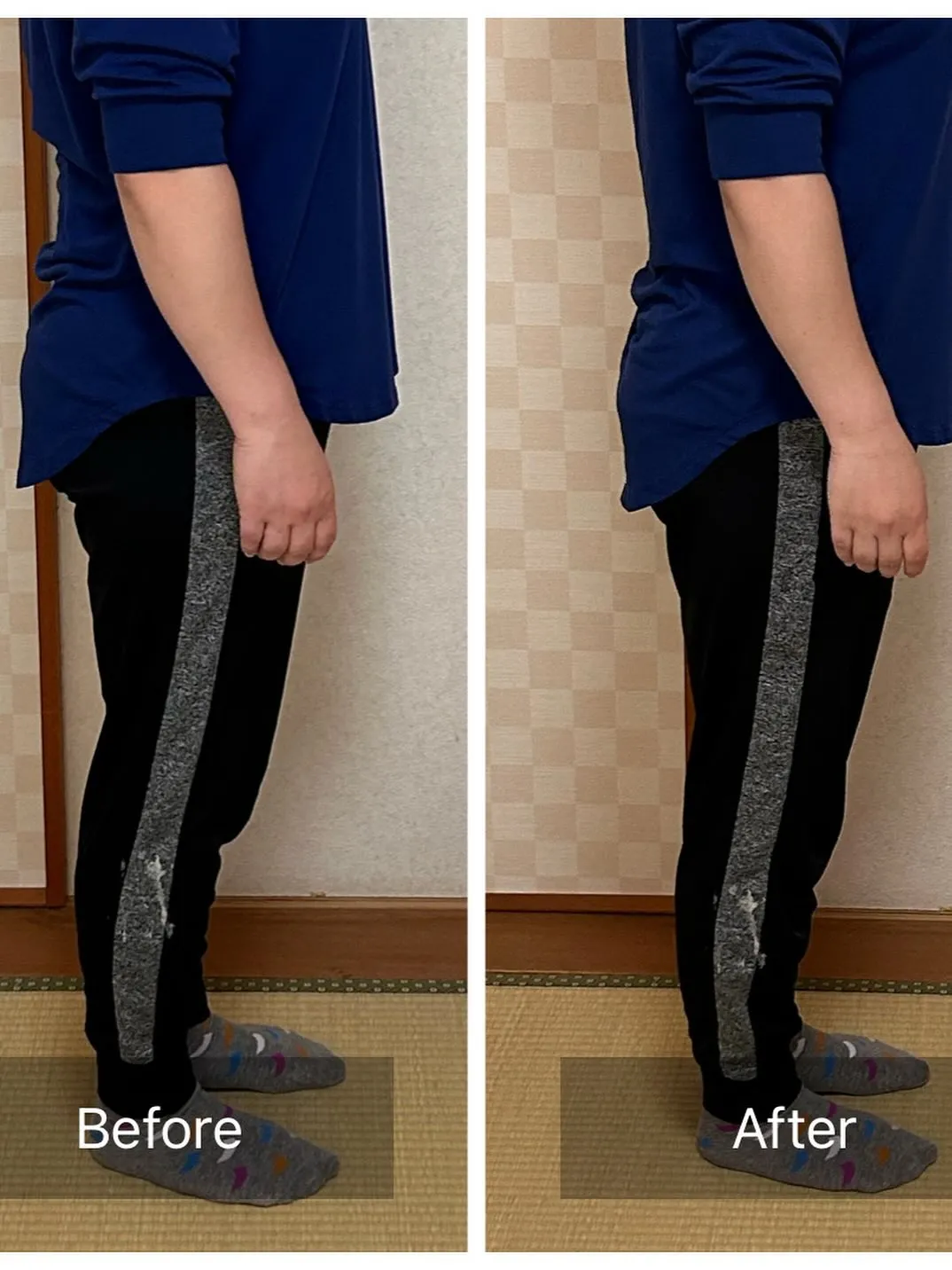 Ｏ脚の原因のひとつとして、骨盤の歪みが挙げられます。