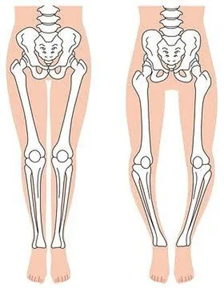 O脚は、多くの人が気にする体の特徴ですが、見た目の問題だけで...