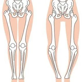 成人以降のO脚の原因について考えてみましょう。